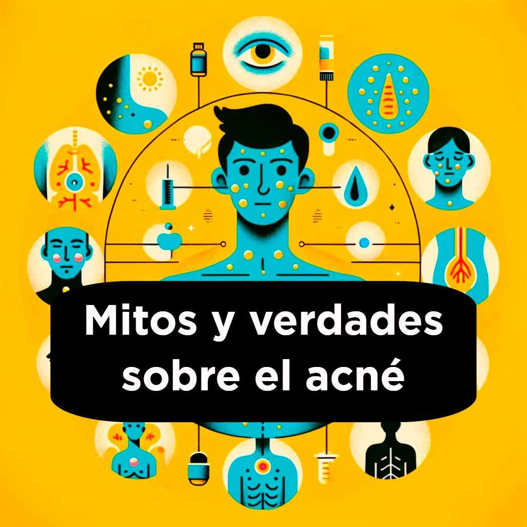 Mitos y verdades sobre el acné